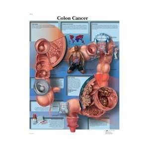 Colon Cancer   Anatomical Chart  Industrial & Scientific