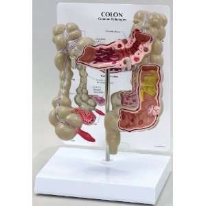 Colon Anatomical Classroom Teaching Model with Cancer Lesion  
