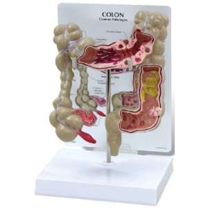 Colon Human Anatomical Model with Pathologies  Industrial 